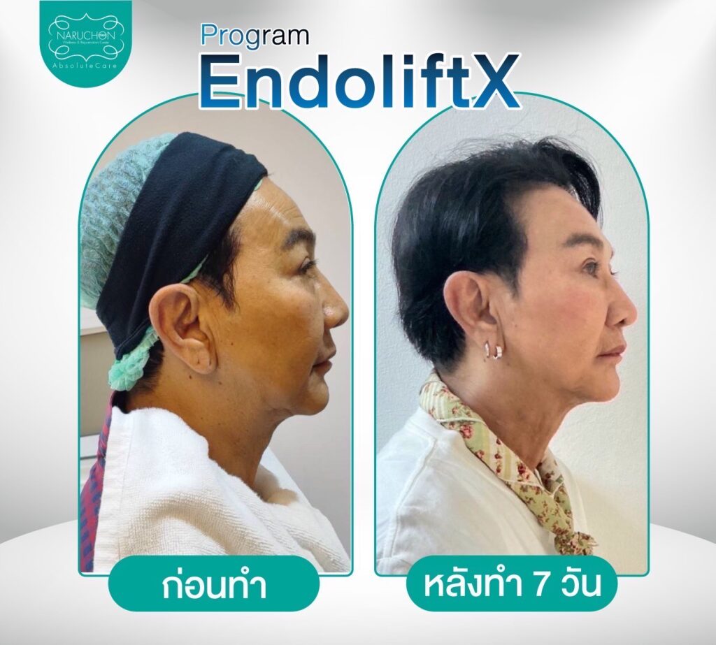 Endolift X ช่วยเรื่องใด